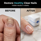 🥳HOT SALE 2026🥳💞50,000+ SOLD!👵❤️ 50% OFF! Portable blue light nail care device